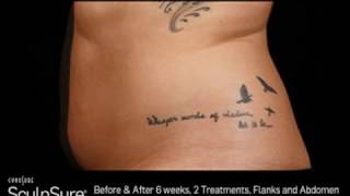 Before And After Sculpsure Video
