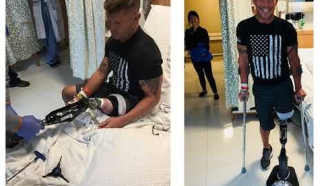 Osseointegration Amputation Reconstruction Surgery