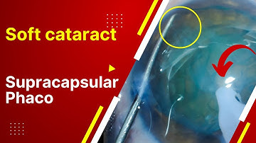Case series 30. Soft cataract supracapsular phaco, tilt and tumble, temporal topical surgery!!