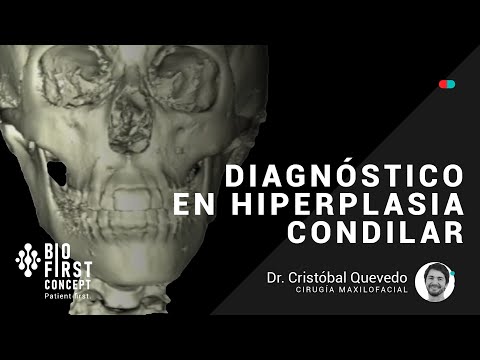 Vídeo: Características Histopatológicas Da Hiperplasia Condilar E Osteocondroma Condilar: Um Estudo Comparativo