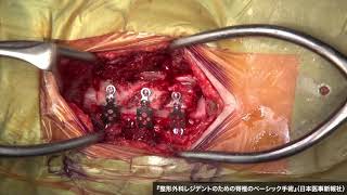 動画8　頚椎症性脊髄症／頚椎後縦靭帯骨化症に対する頚椎椎弓形成術（片開き式）