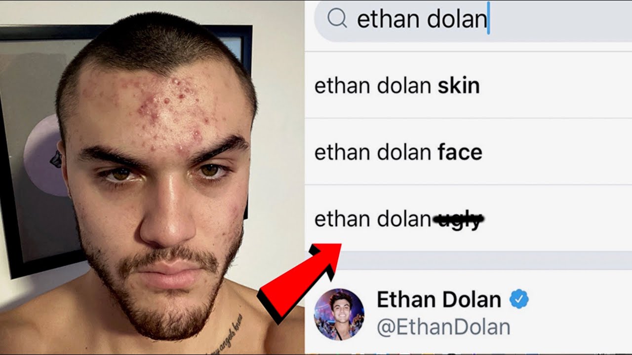 Dolan, Dolan Twins, Ethan, Grayson, Ethan Acne, Ethan Dolan acne,...