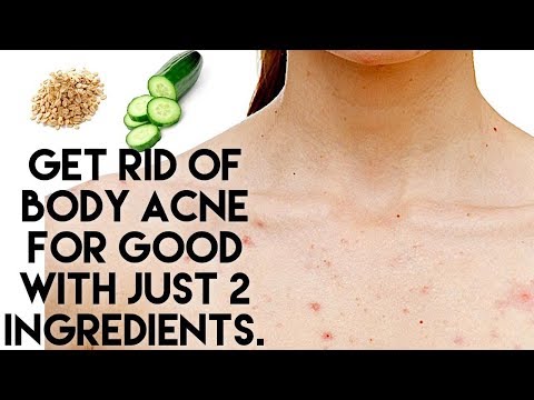 get-rid-of-body-acne-for-good-with-just-2-ingredients.