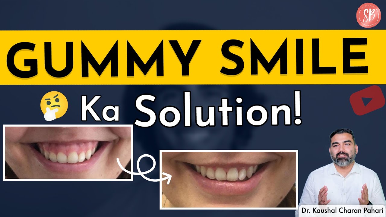 Gummy Smile Kaise Thik Kare | Gummy Smile Solution | Gummy Smile Treatment | SB Aesthetics