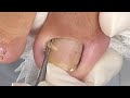 ONICOCRIPTOSE COM ORTESE NO FINAL #satisfying #nails