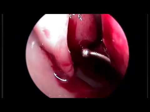 Удаление пломбировочного материала гайморовой пазухи. Maxillary sinus mycetoma removing Камран Гаджи