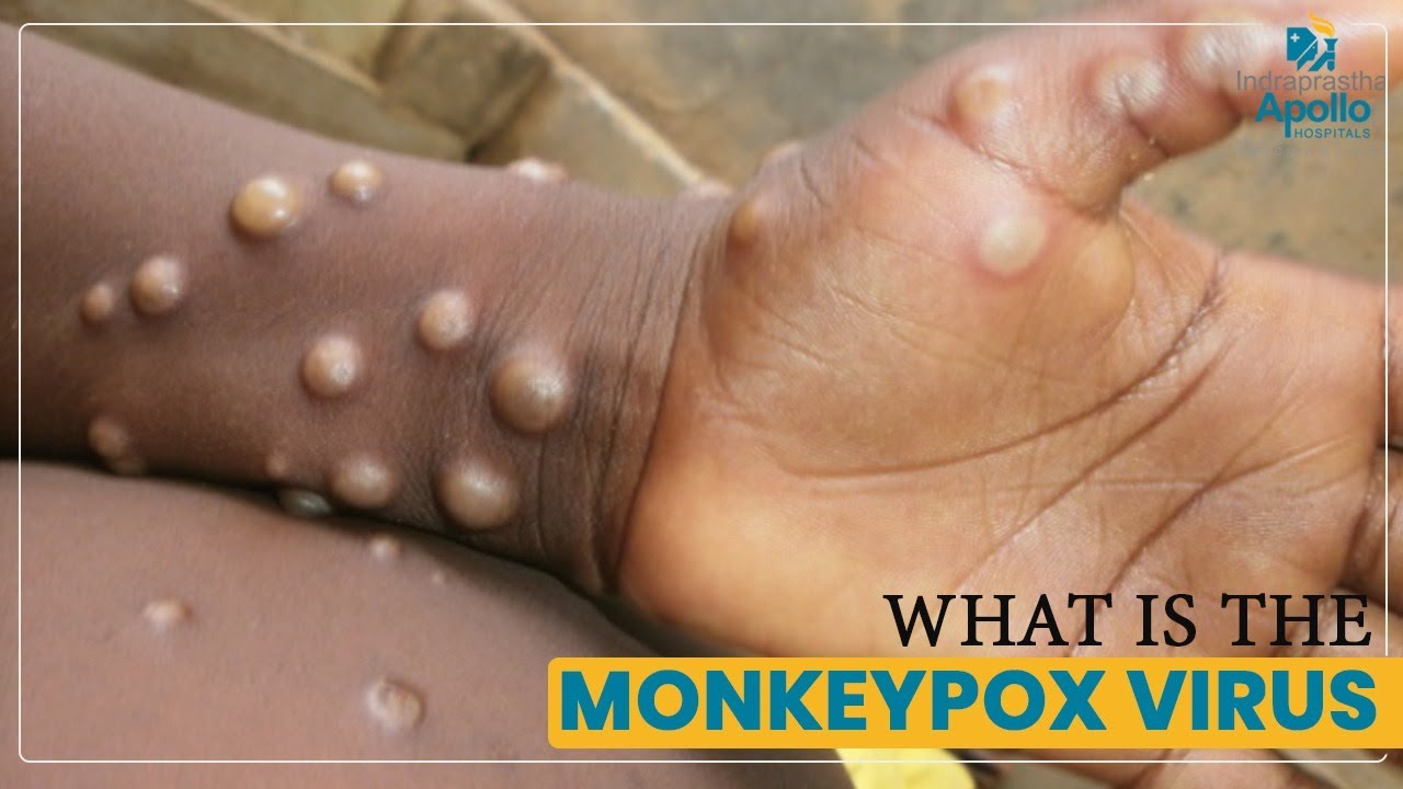 Download What is Monkeypox, Its Symptoms & Causes | Monkeypox Virus Hindi | Dr. Jatin  @Apollo Hospitals ​