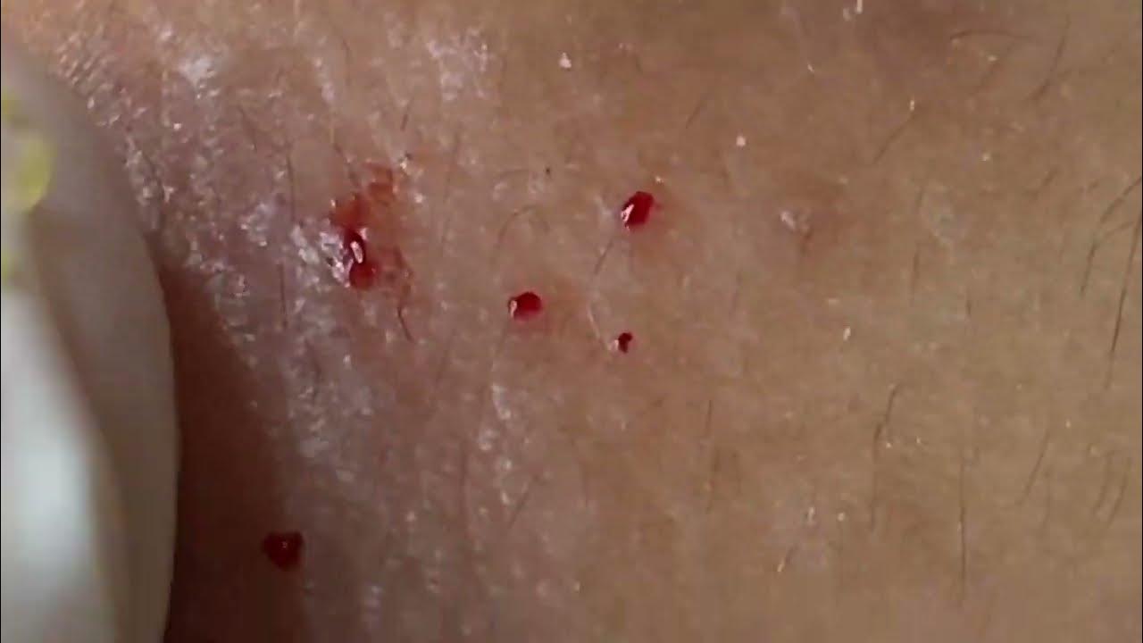 Extreme blackhead Removal at SRN Skin Care Blackhead extraction