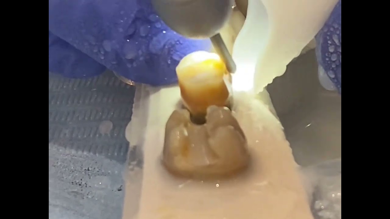 Frank Dental Crown Preparation Diamond Burs