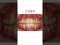 マウスピース矯正 #shorts