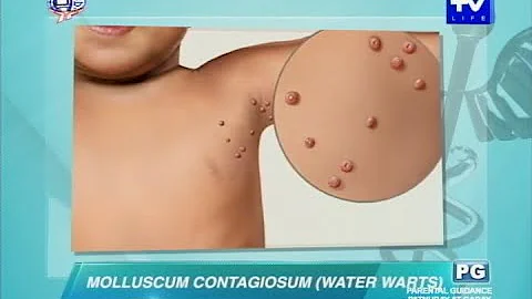 UNTV Life: What causes water warts  in adults and kids?