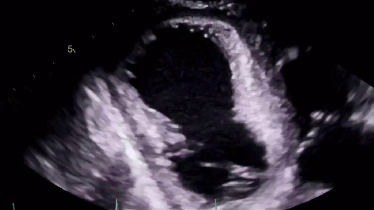 LV thrombus - YouTube