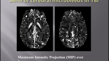 Imaging Traumatic Brain Injury