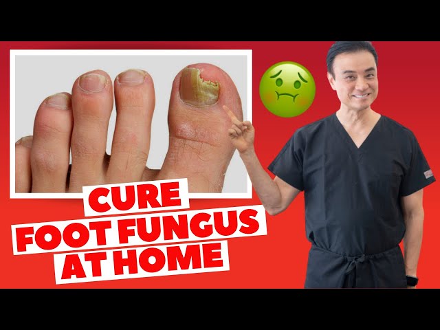 Toenail Fungus Treatment At Home | Footfiles