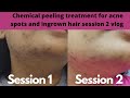 Chemical peel for acne scars before and after 2 session | PCOS acne spots and laser burn peel update