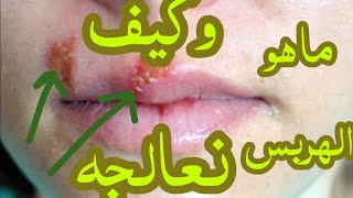 الهربس Herpes خطير ومعدي