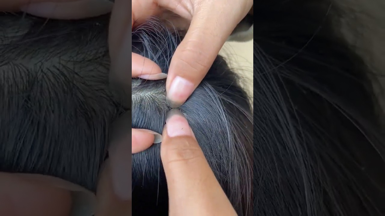 Watch (Part 2) Removing Lice by Hand Satisfying Lice & Nits Removal #liceremoval #licetreatment #lice on YouTube Watch (Part 2) Removing Lice by Hand Satisfying Lice & Nits Removal #liceremoval #licetreatment #lice on YouTube