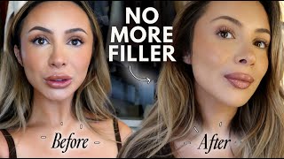 I DISSOLVED ALL OF MY LIP FILLER (before & after) + OFFICE TOUR!! VLOG