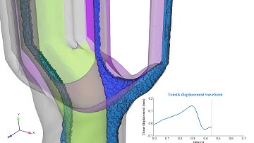 Adaptive grid for moving boundary CFD simulation of CSF flow