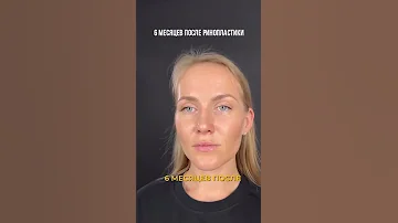 Как нос меняет внешность😍 Ринопластика. Доктор ФИЛИППОВ А.И.