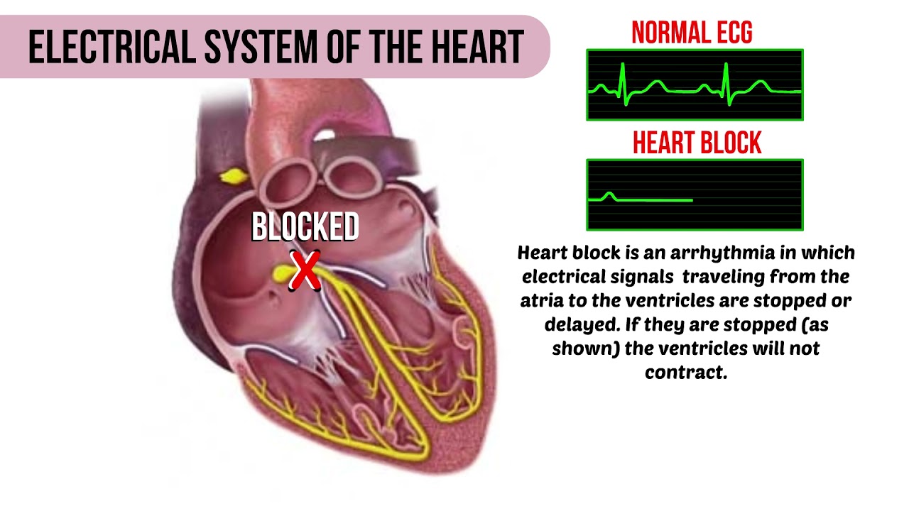 Heart Block YouTube