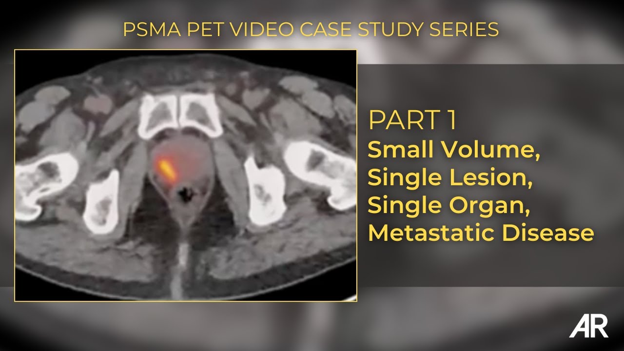 Part 1 | Small Volume, Single Lesion, Single Organ Metastatic Disease