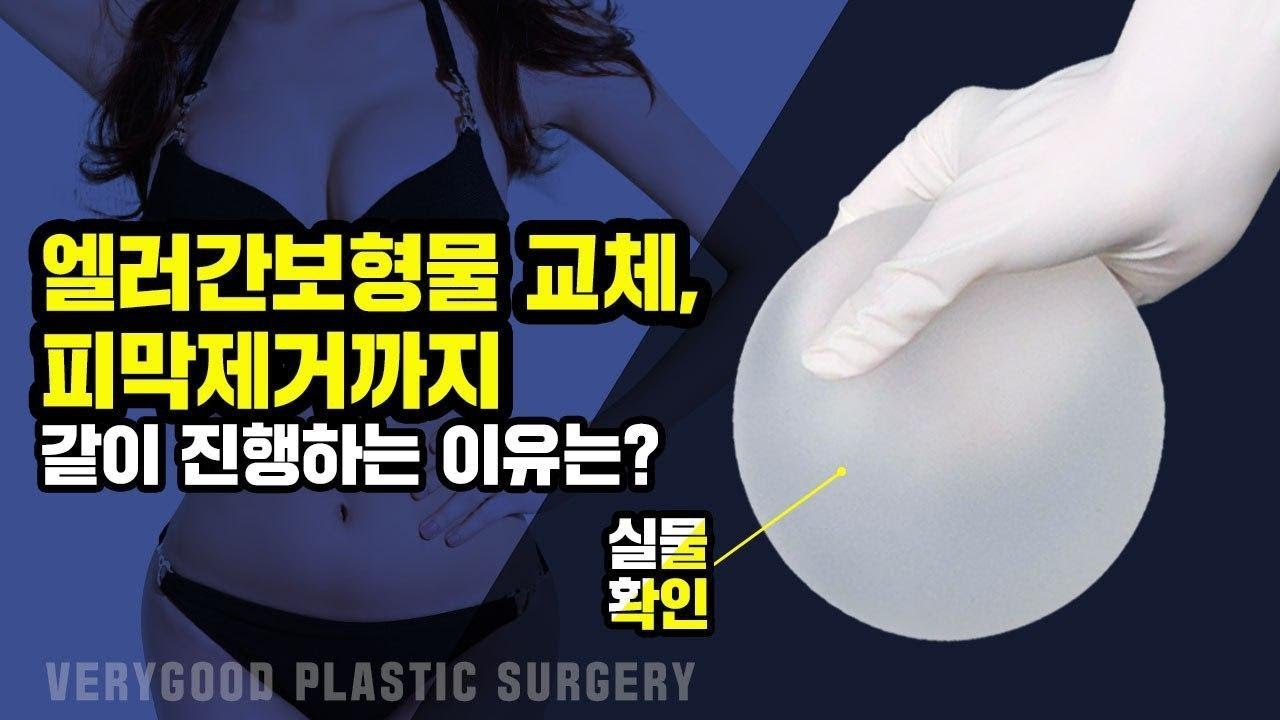 [ВериГүүд гоо сайхны мэс заслын эмнэлэг] Хөхний давтан мэс засал - Эллерган текстурт суулгацыг зайлуулах + Капсулыг бүрэн зайлуулах