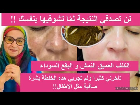 كيف تتخلصين من كلف السنين في أيام فقط بمكونات بسيطة