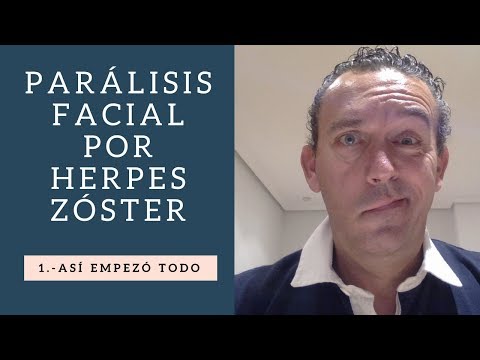 PARÁLISIS FACIAL: Así empezó todo.