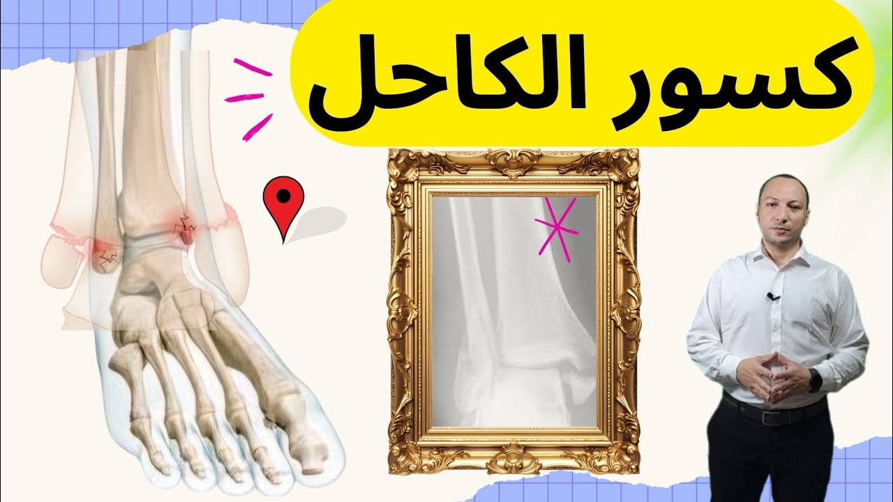 كسور مفصل الكاحل