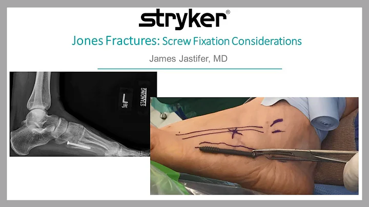 Jones Fractures-Screw Fixation Considerations