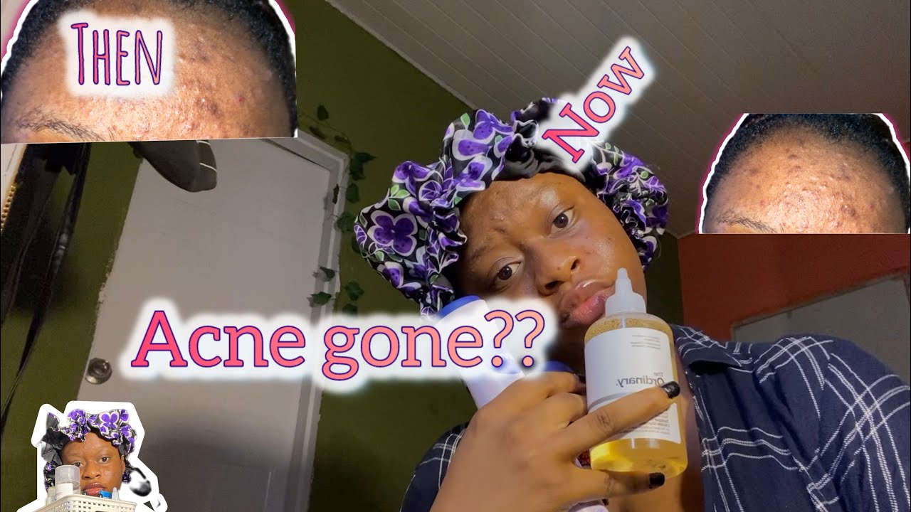 My acne journey; how I clear my acne with these products - YouTube
