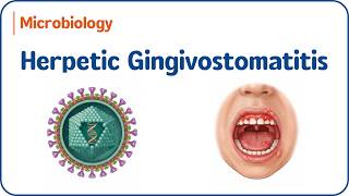 11. Herpetic Gingivostomatitis  🦠🔥 HSV-1 Pathophysiology | USMLE Step 1 🧬👄