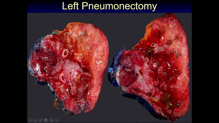 Neuroendocrine Tumors of the Lung Current Diagnostic Criteria & Controversies by Carol Farver, M.D.