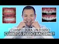 ¿Cuánto Dura un Diseño de Sonrisa? ¿Cuántos diseños me puedo hacer? - Odontología Láser