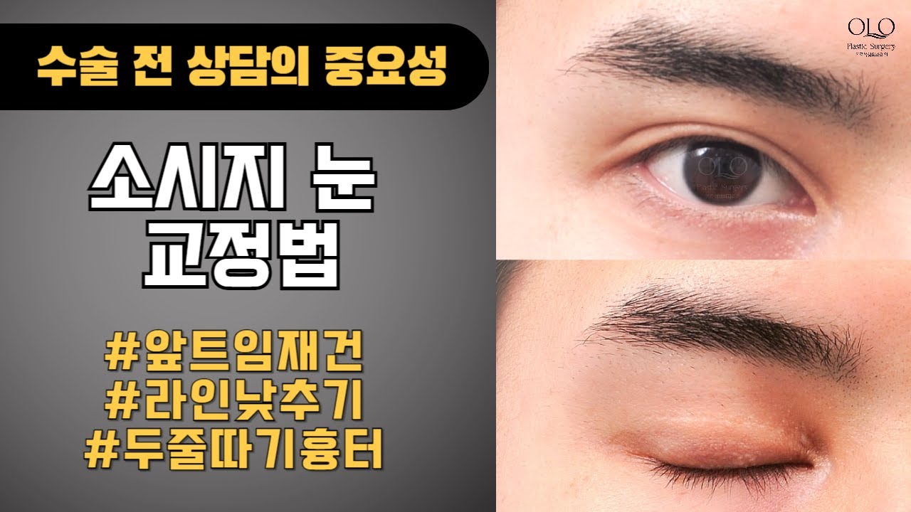 [ОЛО гоо сайхны мэс заслын эмнэлэг] Заавал! Үүнийг үзээд яваарай! Мэс заслын өмнөх зөвлөгөөний ач холбогдол! #Нүдний дотор булангийн засвар #Давхрааны шугам буулгах #Давхар шугам засах #Нүдний дахин мэс засал | Гоо сайхны мэс заслын мэргэжилтэн | Хиам шиг нүд | Нүдний дахин мэс заслын өмнө ба дараа | Сорвины байдал