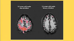 Alcohol and Addiction- How it affects the Brain