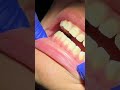 Satisfying Braces Removal ASMR 👀🦷🎧 Tooth Time Family Dentistry