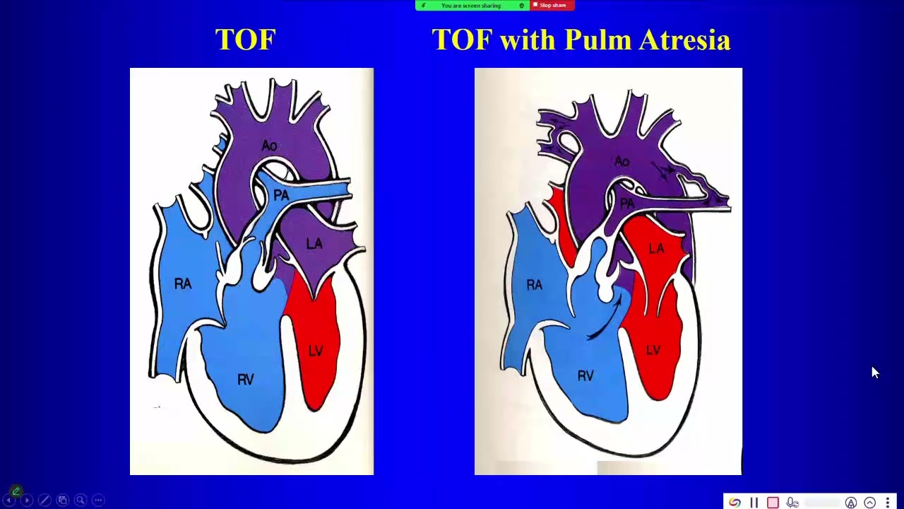 18 Right to Left shunts
