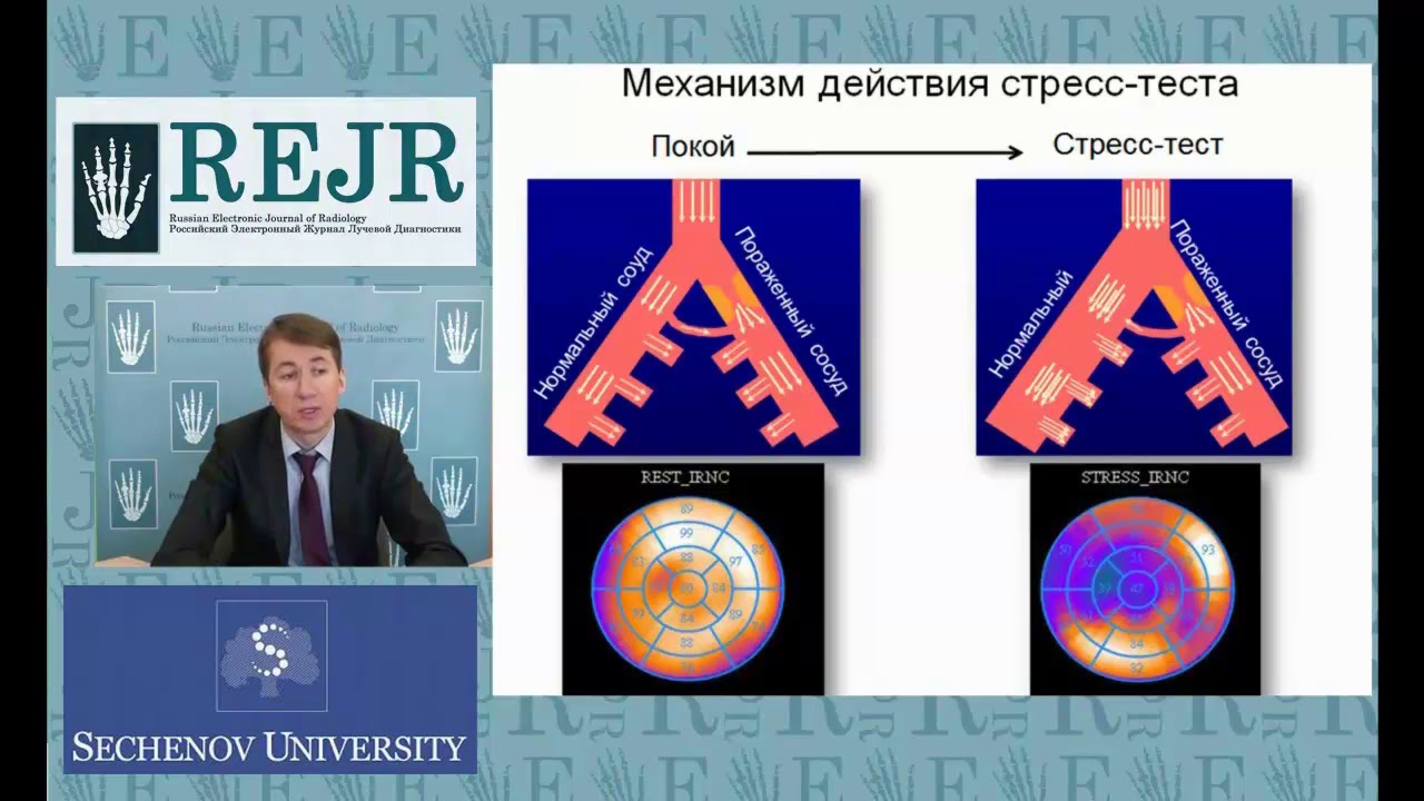 ВОЗМОЖНОСТИ СЦИНТИГРАФИЧЕСКОЙ ДИАГНОСТИКИ ИШЕМИЧЕСКОЙ БОЛЕЗНИ СЕРДЦА
