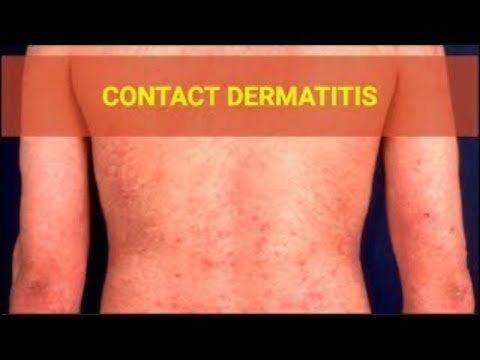 Video: Alergická Kontaktná Dermatitída: Príznaky, Príčiny, Obrázky A ďalšie