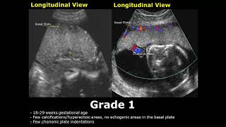 Placental Grading On Ultrasound | Grade 0, 1, 2, 3 Placenta USG screenshot 3