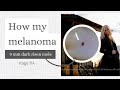 How my melanoma began