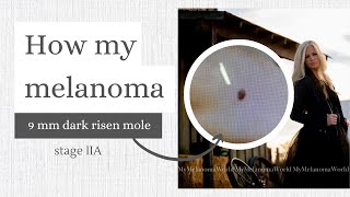 How my melanoma began