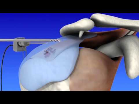 Shoulder Arthroscopy