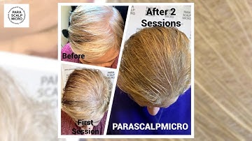 Scalp Micropigmentation Female Crown Density Hair Tattoo