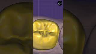 exocad Provisional Module