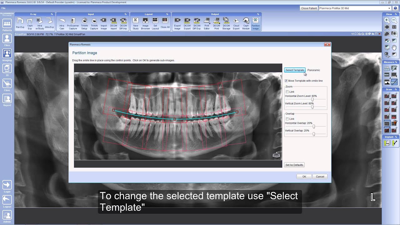 Partitioning a 2D image in Planmeca Romexis®