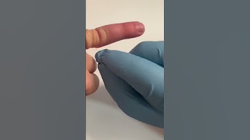 How to Remove a Stuck Ring Using Only Dental Floss