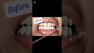 The Fluorosis Teeth How We Poisoned A Generation